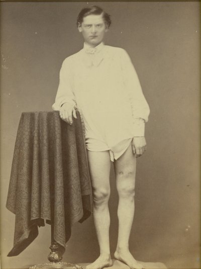 Injured Civil War Soldier (Private Charles Westerfield, Army Medical Museum Specimen No. 4278), April 1865 by William Abraham Bell